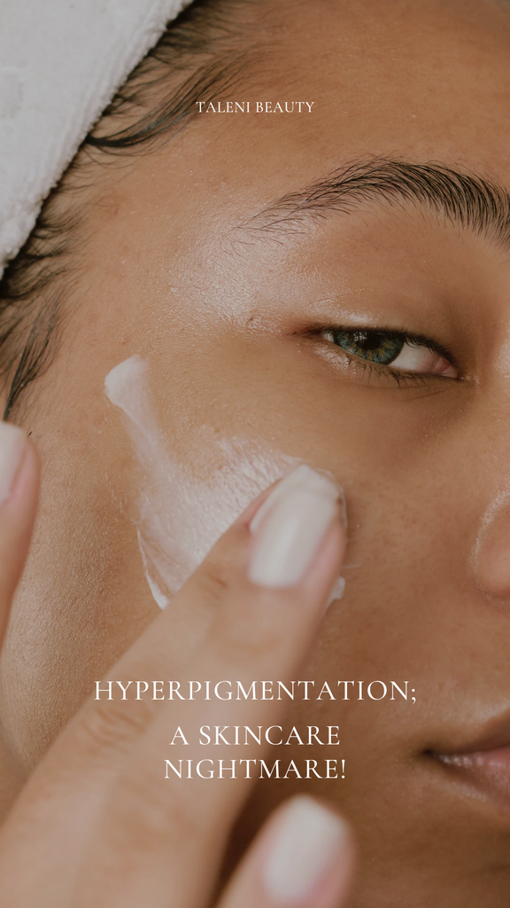 Hyperpigmentation; a skincare nightmare!